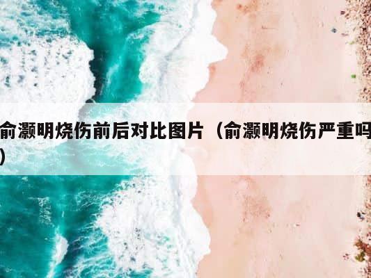 俞灏明烧伤前后对比图片（俞灏明烧伤严重吗） 第1张